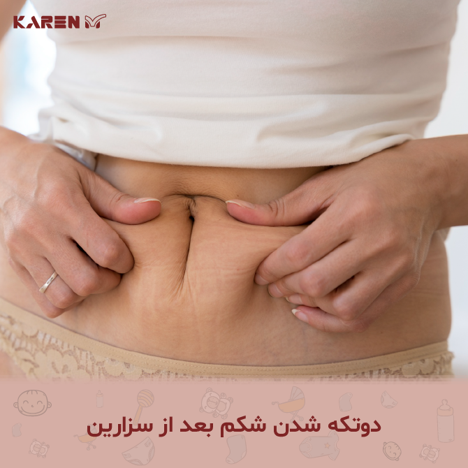 علت بزرگ ماندن شکم بعد از سزارین